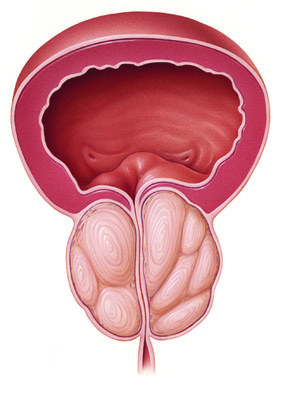 Severe Enlarged Prostate - BPH